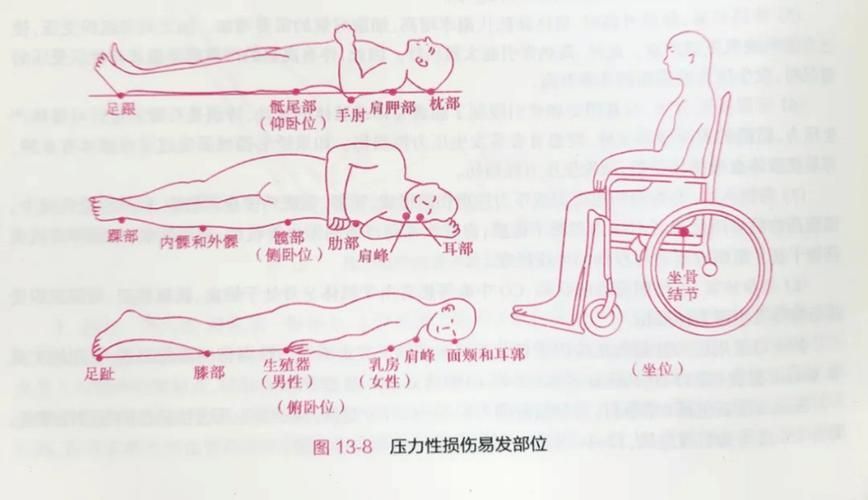 非感染性爛尾如何護理，“非感染性爛尾”如何護理