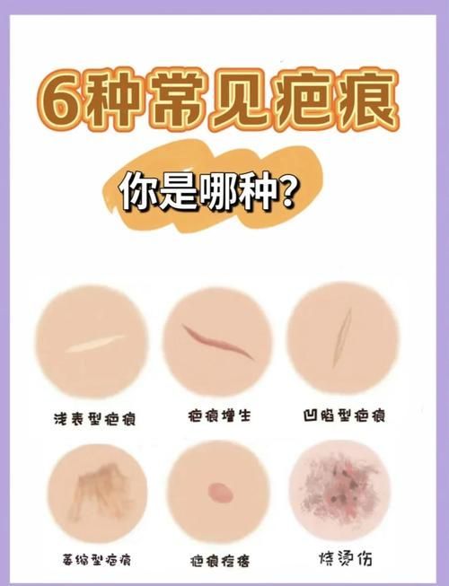 非感染性爛尾如何護理，“非感染性爛尾”如何護理