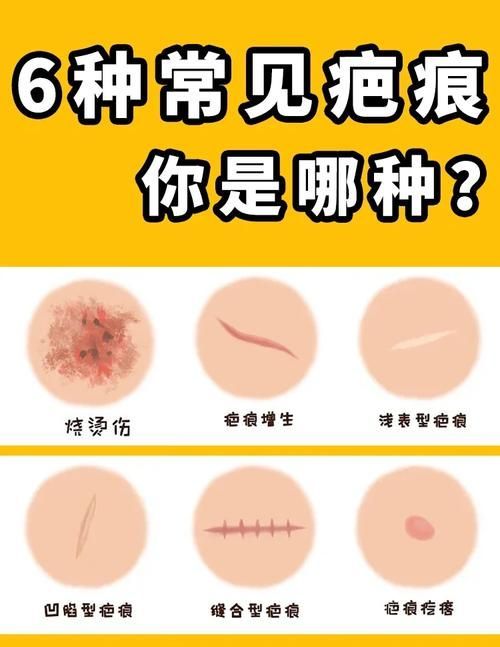 非感染性爛尾如何護理，“非感染性爛尾”如何護理