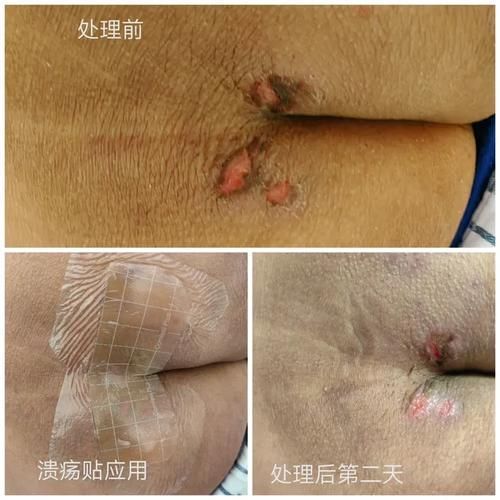 非感染性爛尾如何護理，“非感染性爛尾”如何護理