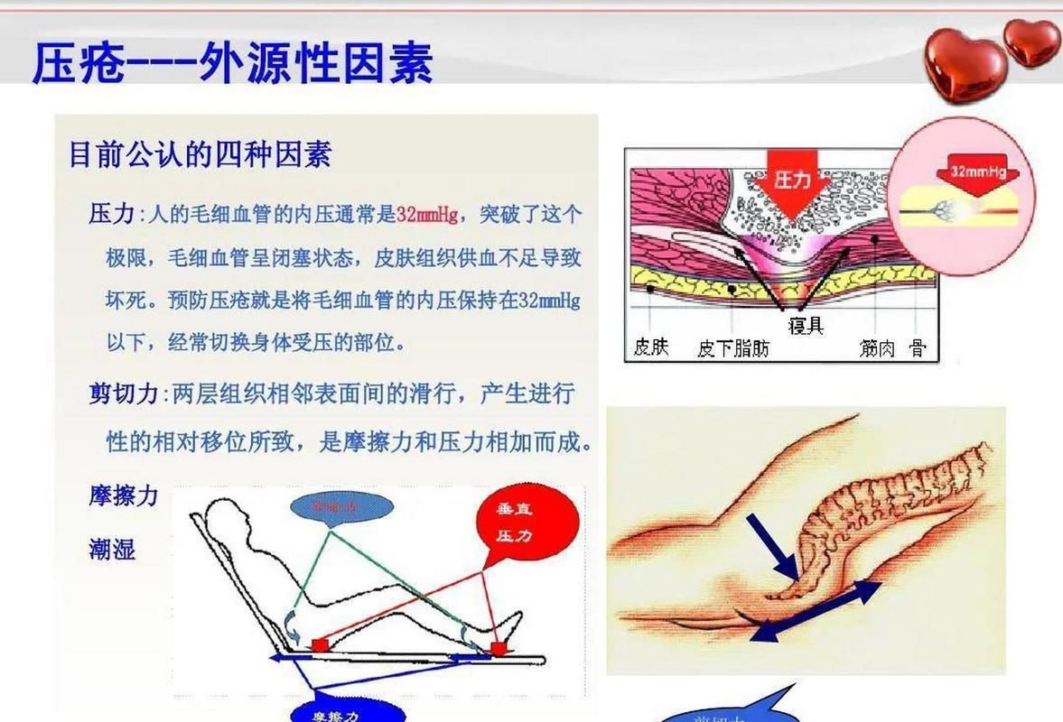 非感染性爛尾如何護理，“非感染性爛尾”如何護理