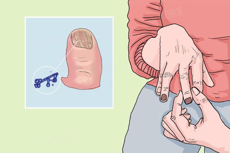 真菌和細菌感染哪個更常見？，真菌感染和細菌感染的區別