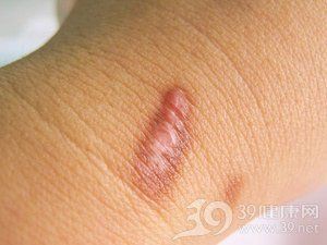 魚鱗變紅滲血會留下疤痕嗎？【魚鱗變紅滲血會留下疤痕嗎】 魚鱗變紅滲血會留下疤痕嗎？【魚鱗變紅滲血會留下疤痕嗎】 龍魚百科