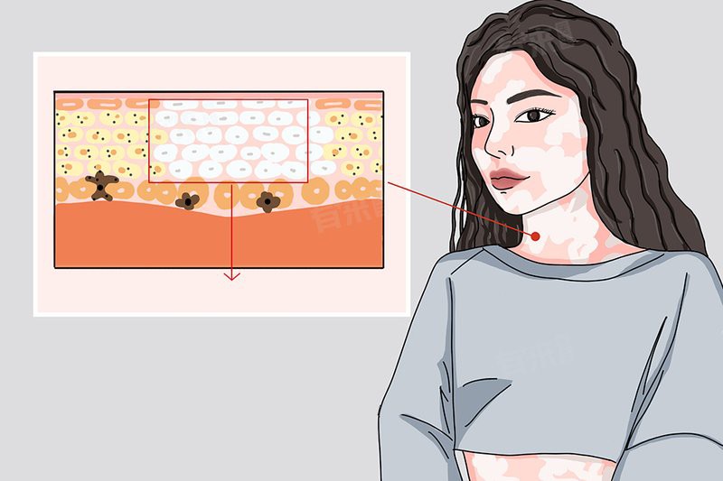 白點病是什么原因造成的【白點病是什么原因造成的劉雯敏白點病是什么原因造成的】