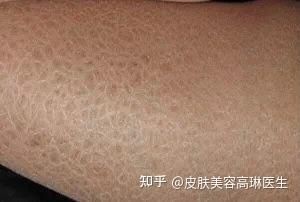 魚鱗病一般活不過40歲嗎【關(guān)于“魚鱗病一般活不過40歲”的說法缺乏科學依據(jù)】