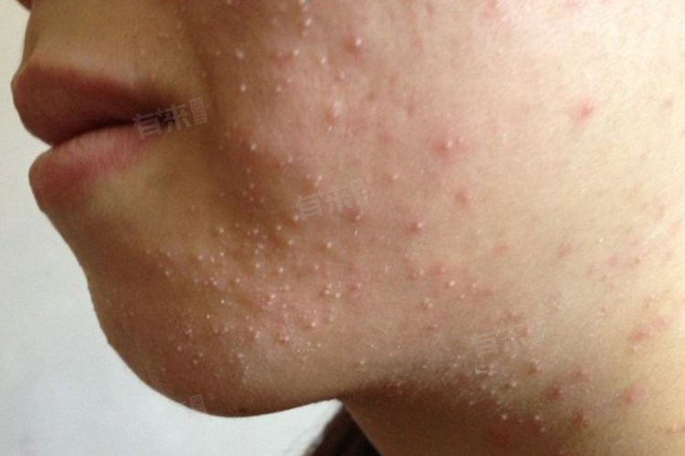 痘痘和hpv怎么區分【《痘痘和hpv怎么區分》痘痘與hpv感染引發的皮損常易混淆】