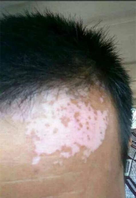 白點病初期圖片【寶寶脖子上有白色小圓點是怎么回事】