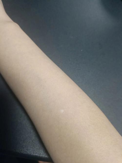 白點病初期圖片【寶寶脖子上有白色小圓點是怎么回事】