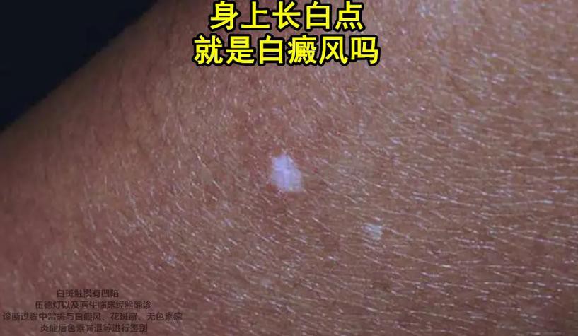 白點病初期圖片【寶寶脖子上有白色小圓點是怎么回事】
