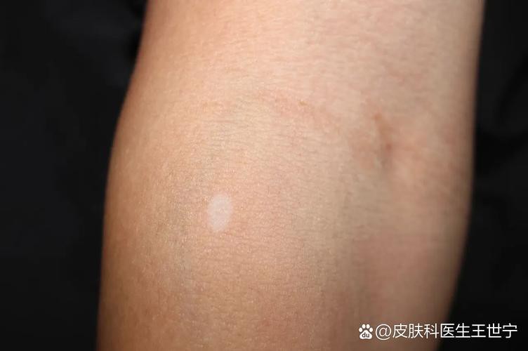 白點病初期圖片【寶寶脖子上有白色小圓點是怎么回事】