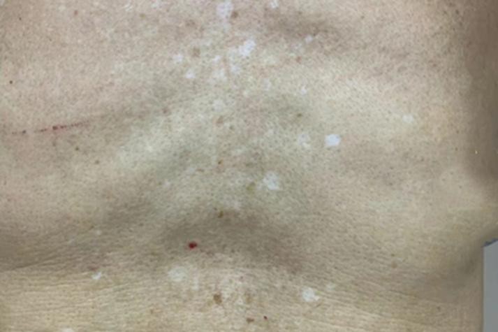 白點病初期圖片【寶寶脖子上有白色小圓點是怎么回事】