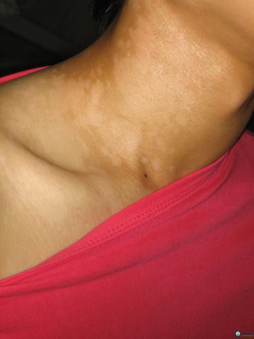 白點病初期圖片【寶寶脖子上有白色小圓點是怎么回事】