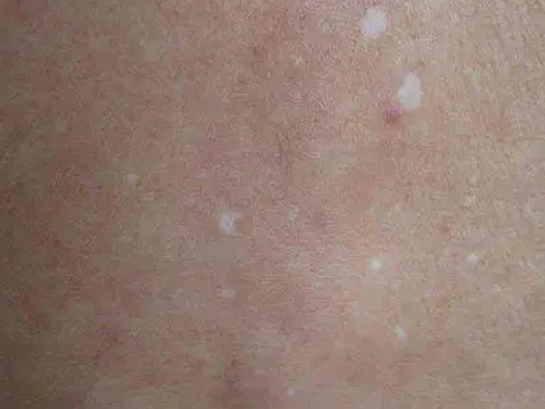 白點病初期圖片【寶寶脖子上有白色小圓點是怎么回事】