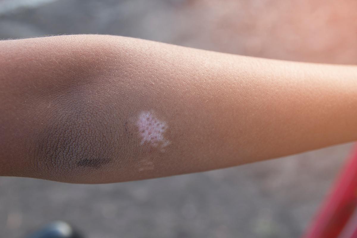 白點病初期圖片【寶寶脖子上有白色小圓點是怎么回事】