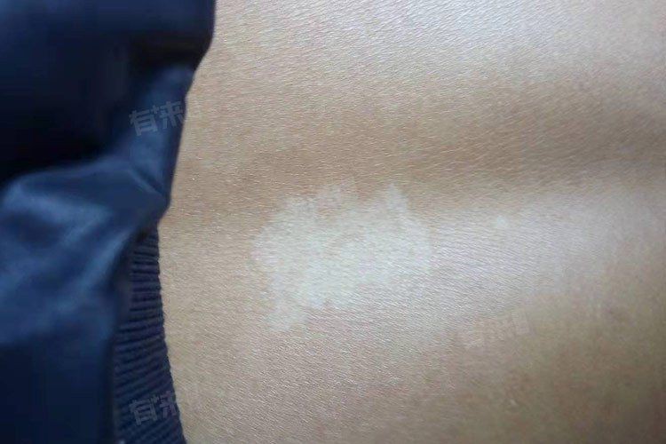 白點病會自愈嗎？【白點病會自愈嗎】