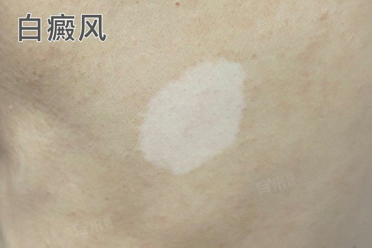 白點(diǎn)病有哪些典型癥狀？，什么是白點(diǎn)病