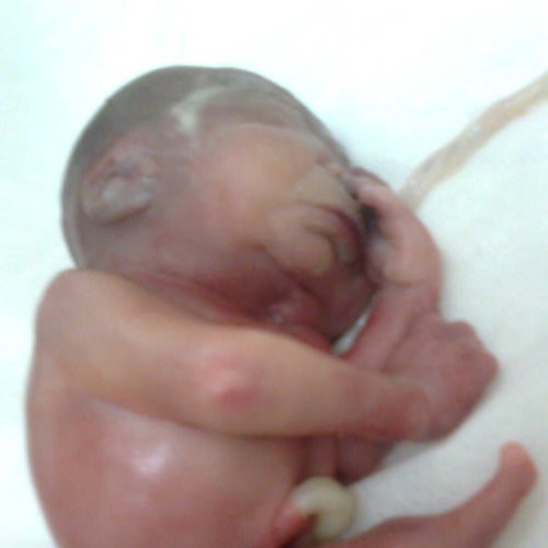 什么是美人魚綜合癥，關(guān)于美人魚綜合癥