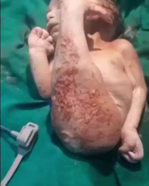 什么是美人魚綜合癥，關(guān)于美人魚綜合癥