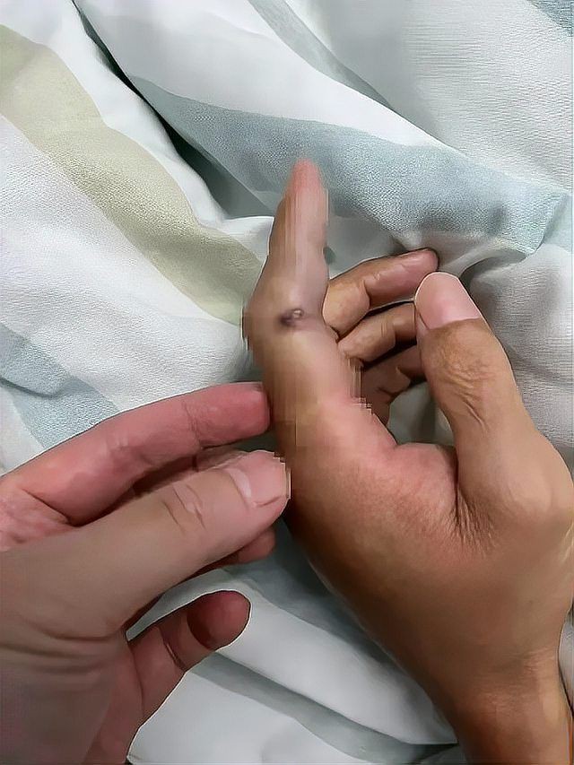 海洋弧菌感染的死亡率有多高？，光明網(wǎng),創(chuàng)傷弧菌:海洋中的隱形殺手