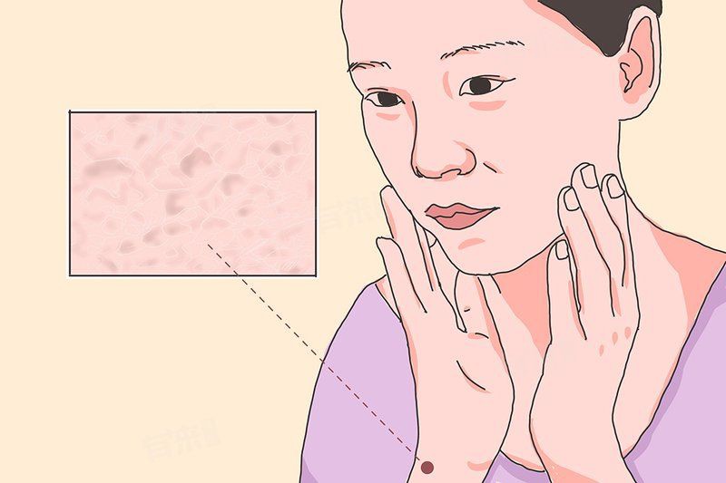 魚鱗病能徹底治愈嗎？，主任醫師三甲,魚鱗病能根治嗎