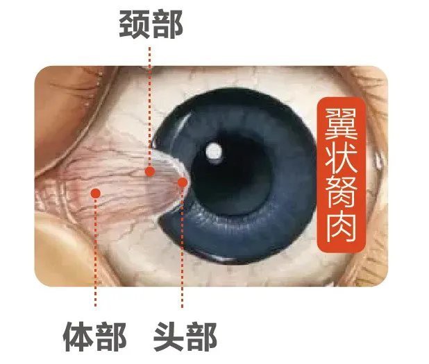 人長魚眼是什么樣子的，應長“魚眼”是什么樣子的
