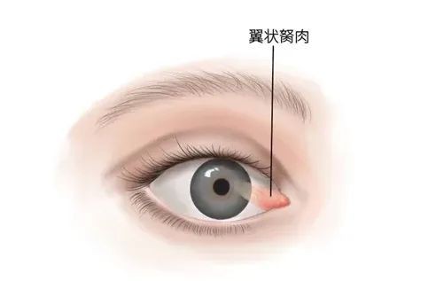 人長魚眼是什么樣子的，應長“魚眼”是什么樣子的