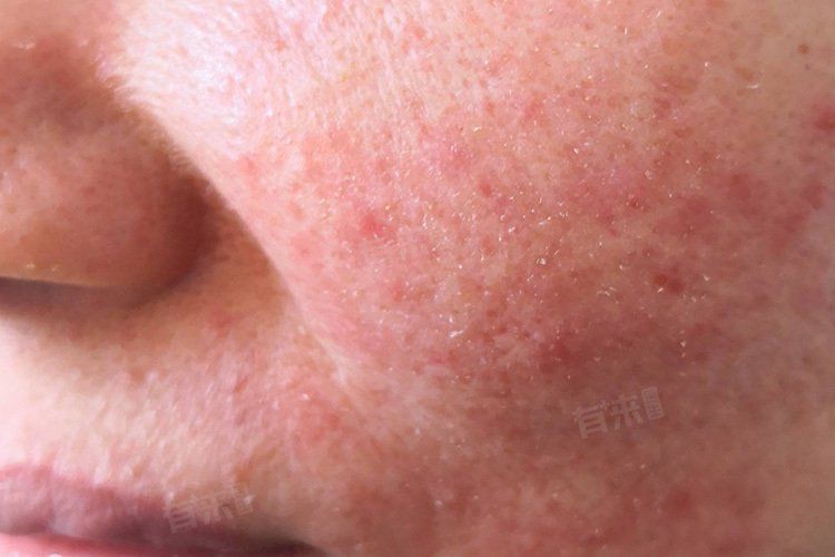 玫瑰膠囊吃了6個月臉垮了，任培華副主任醫師三甲玫瑰膠囊長期吃有副作用嗎