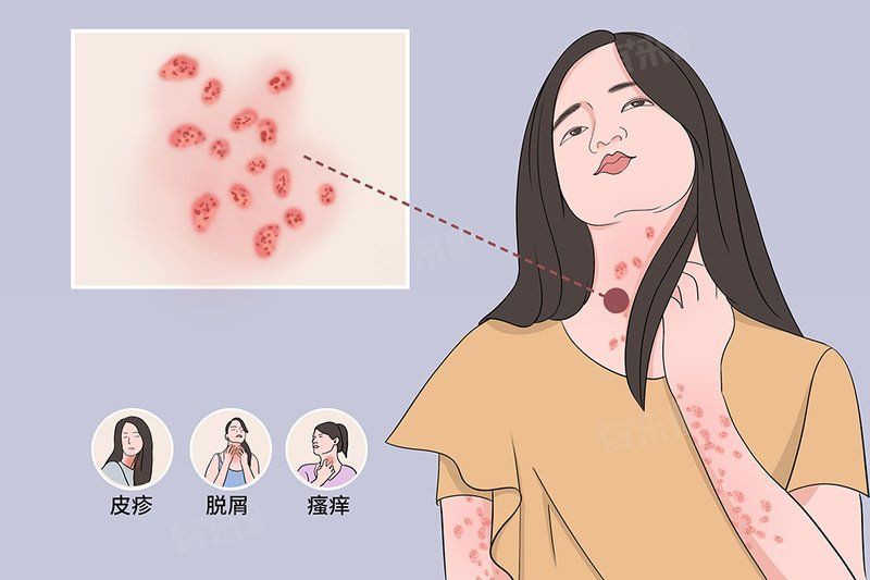 玫瑰糠疹用什么藥好，玫瑰糠疹吃什么藥物