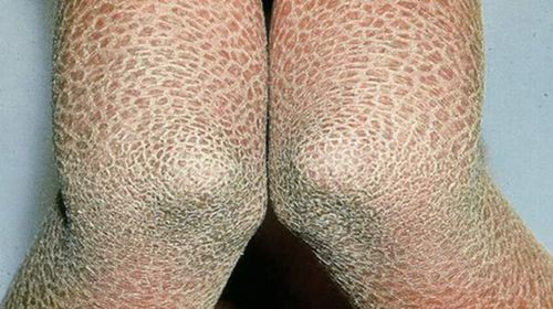 提供幾張豎鱗病的圖片，魚豎鱗病怎么治