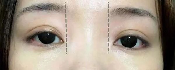 龍魚眼下垂怎么治療：龍魚眼下垂可能由多種原因引起，治療方法也有所不同