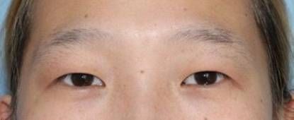 龍魚眼下垂怎么治療：龍魚眼下垂可能由多種原因引起，治療方法也有所不同