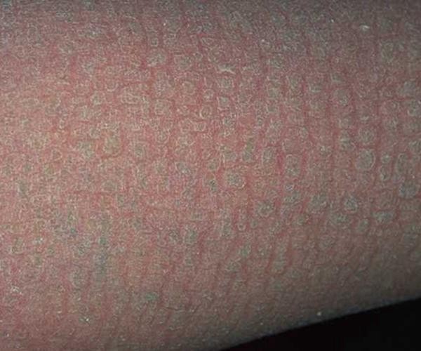 銀龍魚鱗片爛了怎么辦圖片大全