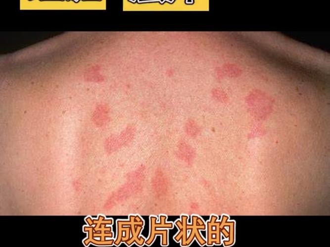 龍眼紅眼需要如何調養