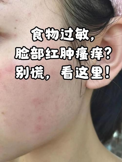 龍眼紅眼需要如何調養
